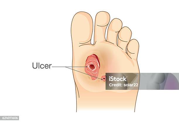 Diabetic Foot Pain And Ulcers Stock Illustration - Download Image Now - Ulcer, Wound, Diabetes