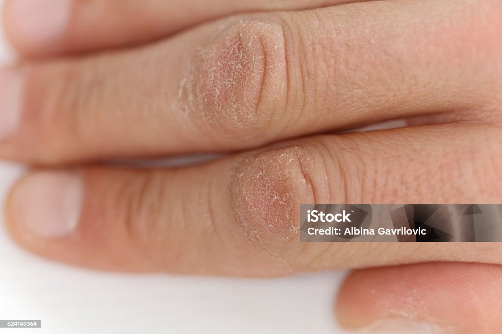 Male hands close up, chapped skin, winter skin care concept Dry Stock Photo