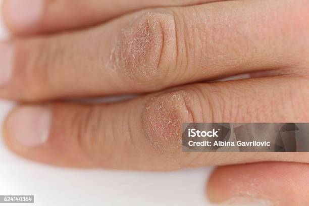 Male Hands Close Up Chapped Skin Winter Skin Care Concept Stock Photo - Download Image Now