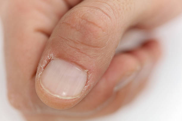 istock Man hands close up, dry cuticle, chapped skin 624140380