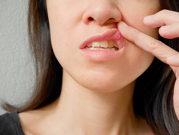 aftas en el labio superior de la mujer - thrush fotografías e imágenes de stock