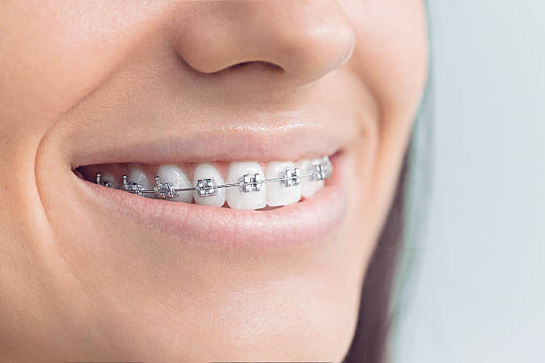 Woman with brackets stock photo