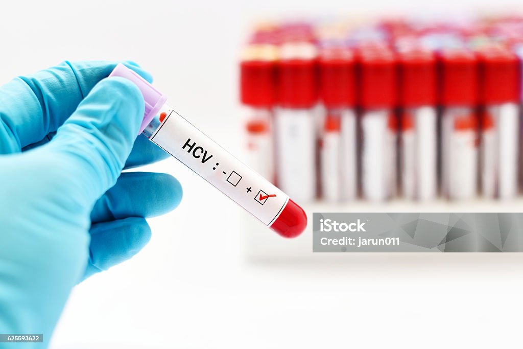 HCV positive Blood sample with hepatitis C virus (HCV) positive Blood Stock Photo