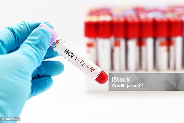 Hcv Positive Stock Photo - Download Image Now - Blood, Blood Donation, Blood Test
