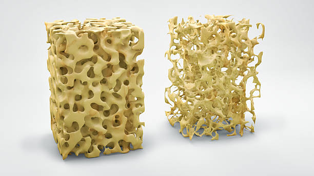 knochenstruktur 3d-illustration, normal und mit osteoporose - osteoporose stock-fotos und bilder
