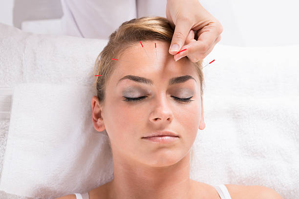 istock Hand Performing Acupuncture Therapy On Patient's Head 625906792