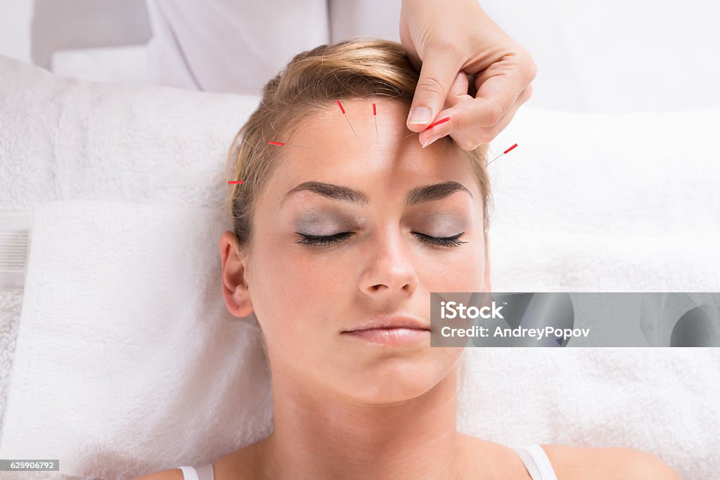 Hand Performing Acupuncture Therapy On Patient's Head Closeup of hand performing acupuncture therapy on patient's head at salon Acupuncture Stock Photo