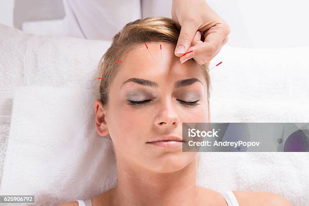 Hand Performing Acupuncture Therapy On Patients Head Stock Photo - Download Image Now