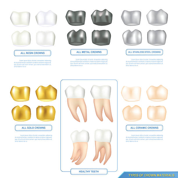 infographics types of dental crown materials with healthy teeth infographics types of dental crown materials with healthy teeth, ceramic, resin, metal and stainless-steel dental gold crown stock illustrations
