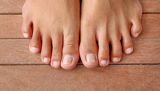 istock Damaged toenail, broken nail 626186280