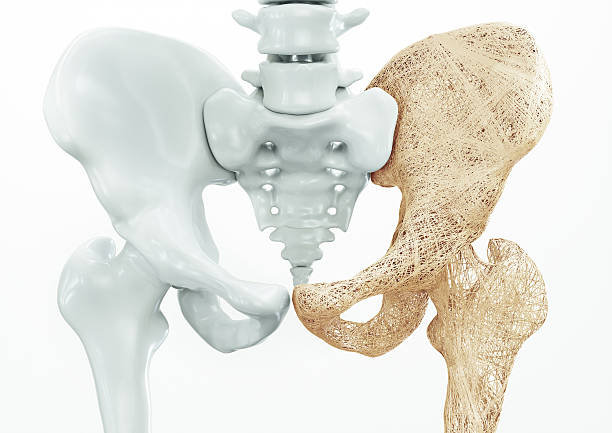 osteoporose - oberschenkelknochen - 3d rendering - osteoporose stock-fotos und bilder