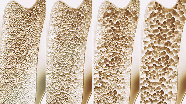 osteoporose 4 stufen - 3d rendering - osteoporose stock-fotos und bilder