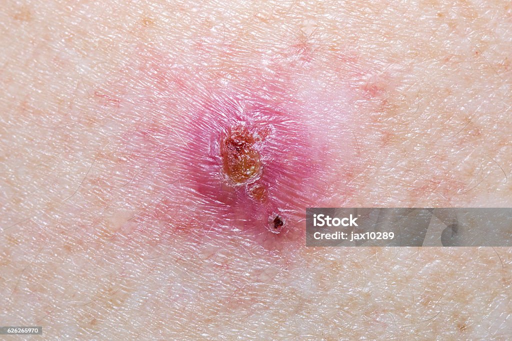 Basal Cell Carcinoma Close-up of a Basal Cell Carcinoma  Basal Cell Carcinoma Stock Photo