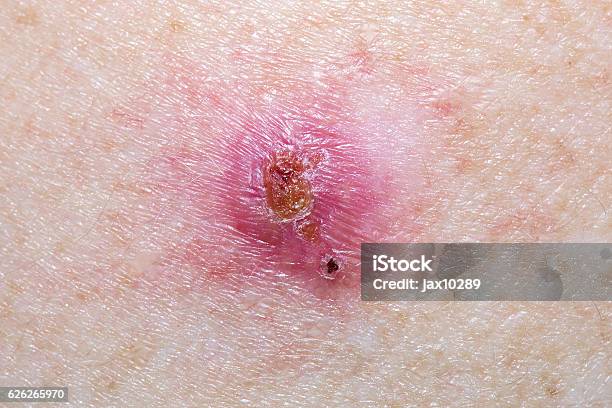 Basal Cell Carcinoma Stock Photo - Download Image Now - Basal Cell Carcinoma, Skin Cancer, Physical Injury