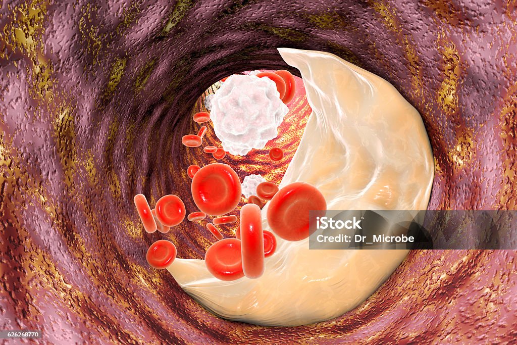 Atheroma-Plakette in der Arterie - Lizenzfrei Abnehmen Stock-Foto