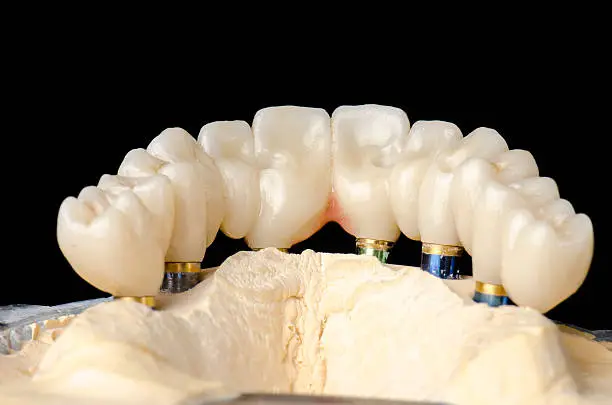 Photo of Monolithic zirconia restorations full arch implant