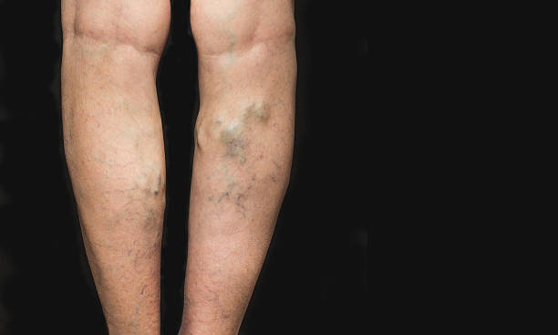 Varicose veins on a female legs The varicose veins on a legs of old woman on black varicose vein stock pictures, royalty-free photos & images
