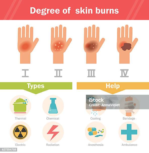 Degree Of Skin Burns Vector Stock Illustration - Download Image Now - Burning, Anatomy, Damaged