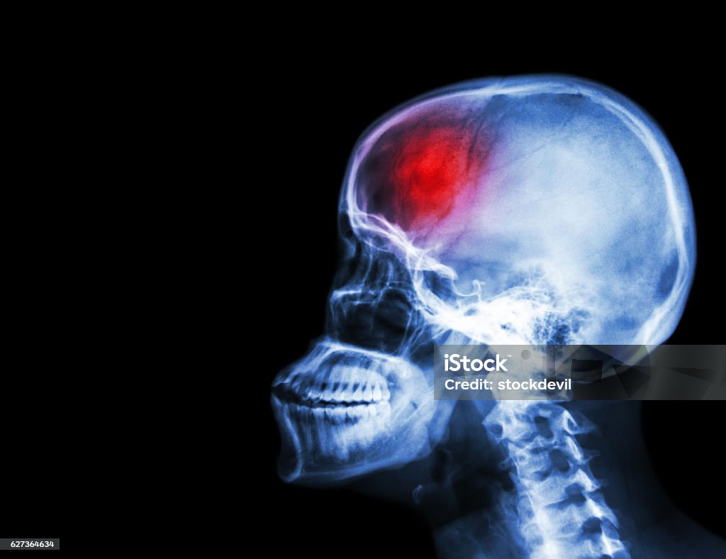 Stroke Stroke . film x-ray skull and cervical spine lateral view and stroke . cerebrovascular accident . blank area at left side . Aggression Stock Photo