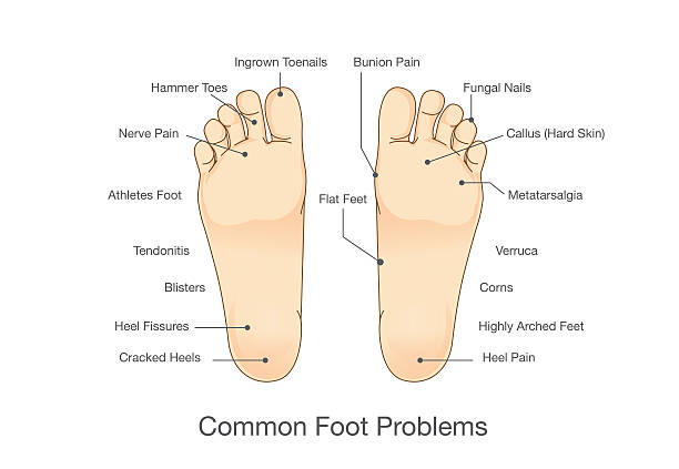 ilustrações, clipart, desenhos animados e ícones de problemas comuns no pé. - sole of foot