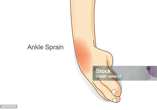 Ankle Sprain And Swelled Stock Illustration - Download Image Now - Ankle, Sprain, Ligament