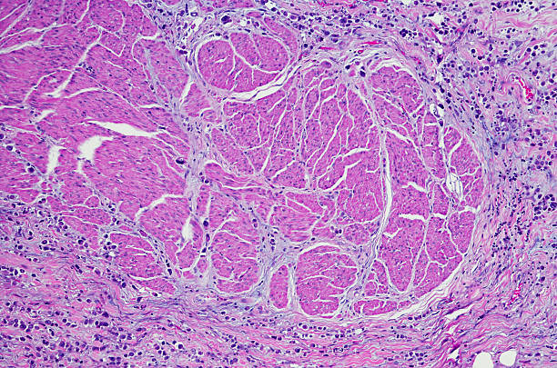 istock Plasmacytoid variant of urothelial carcinoma 628024300
