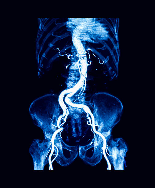 angiografia de tomografia computadorizada (cta) de aorta abdominal - cat scan pelvis hip human spine - fotografias e filmes do acervo