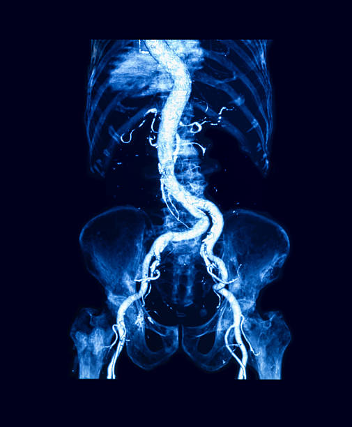 腹部大動脈のコンピュータ断層撮影(cta) - cat scan pelvis hip human spine ストックフォトと画像