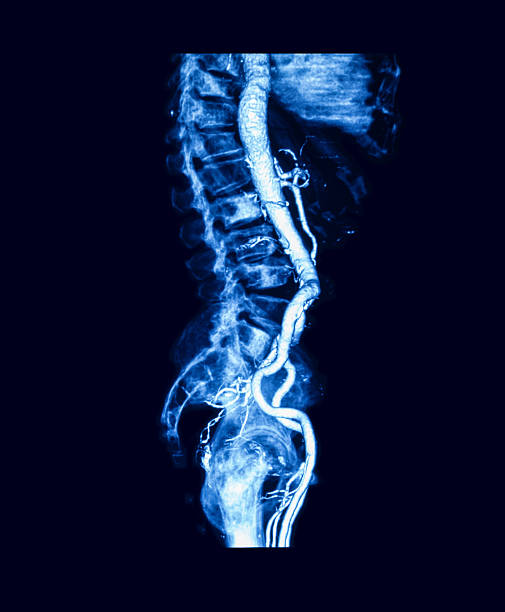 angiografia de tomografia computadorizada (cta) de aorta abdominal - cat scan pelvis hip human spine - fotografias e filmes do acervo