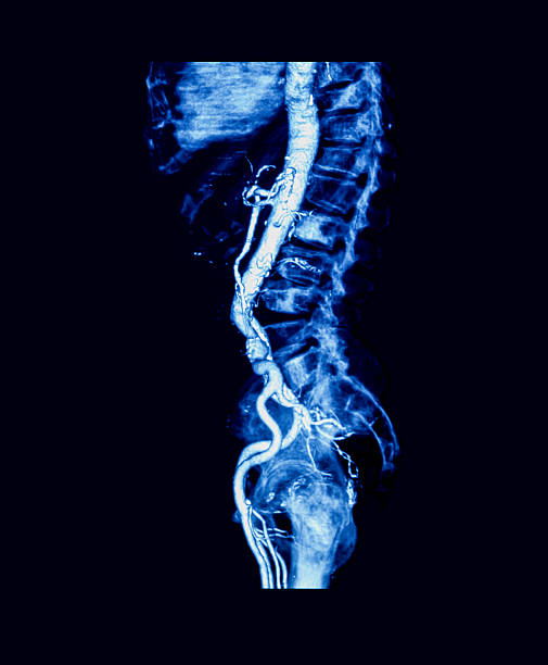 angiografia de tomografia computadorizada (cta) de aorta abdominal - cat scan pelvis hip human spine - fotografias e filmes do acervo