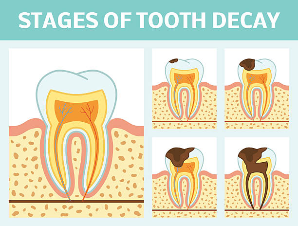 Tooth decay stages Vector illustration of tooth decay. Four stages of dental caries. abscess stock illustrations