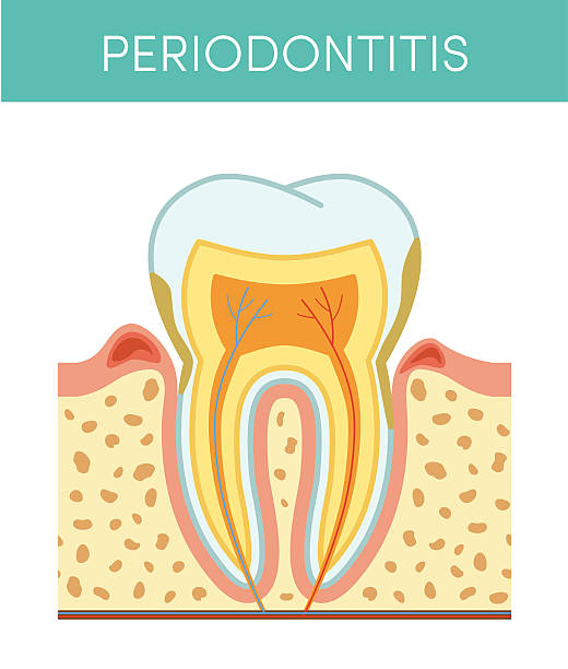 ząb z zapaleniem przyzębia - human teeth gums dental hygiene inflammation stock illustrations