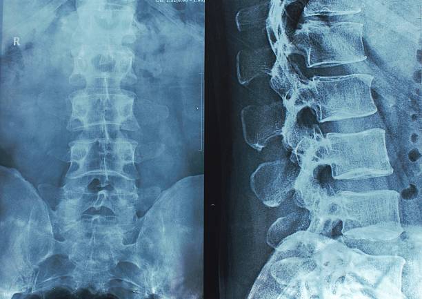 röntgenaufnahmen der wirbelsäule - lähmung stock-fotos und bilder