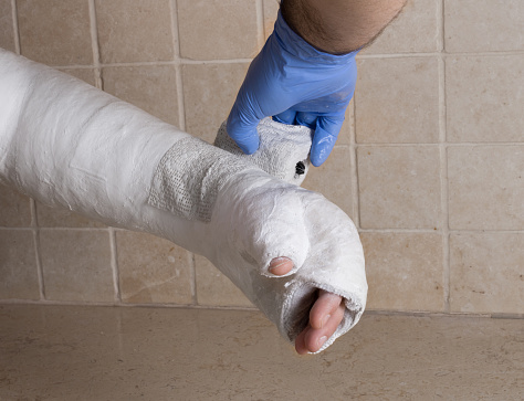 Different Cast Orthopedic Technician Putting On A Fiberglass Plaster Cast Stock Photo ...