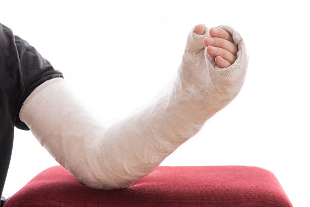 istock Long arm plaster / fiberglass cast resting on ottoman 628361978
