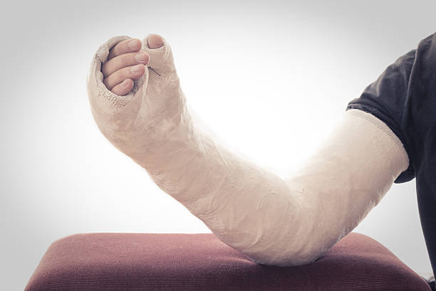 istock Long arm plaster / fiberglass cast resting on ottoman 628438364
