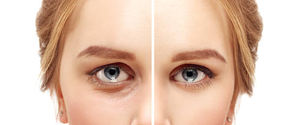 niższe blepharoplasty.upper blepharoplasty - wrinkle treatment zdjęcia i obrazy z banku zdjęć