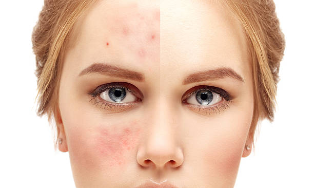 Girl with problem and clear skin. Portrait of girl with problem and clear skin skin condition photos stock pictures, royalty-free photos & images