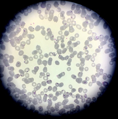 Plasmodium falciparum is the most dangerous form of malaria. Numerous parasites have infected the red blood cells of this patient. The parasites can be seen as little rings inside the red blood cells in.this thin blood smear.  Malaria is spread by mosquitoes.