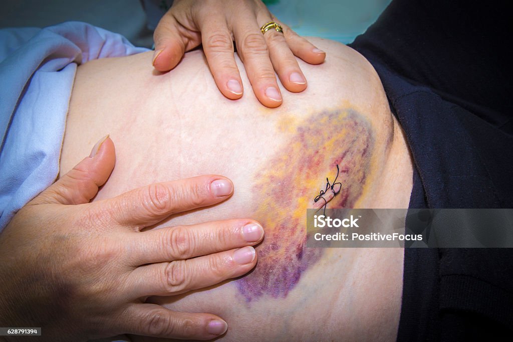 Laparoscopic Surgery Scars And Bruises Stock Photo - Download Image Now -  Endometriosis, Wound, Adult - iStock