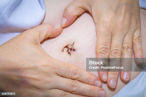 Laparoscopic Surgery Scars And Bruises Stock Photo - Download Image Now - Adult, Appendicitis, Appendix