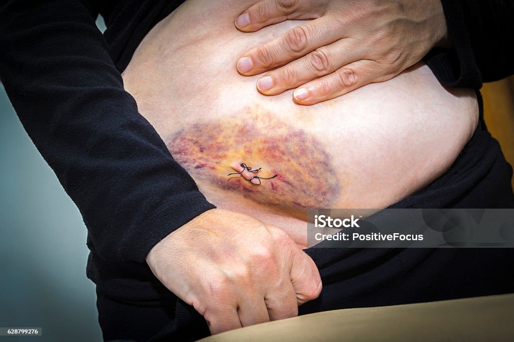 Laparoscopic Surgery Scars And Bruises Stock Photo - Download Image Now -  Endometriosis, Appendicitis, Adult - iStock