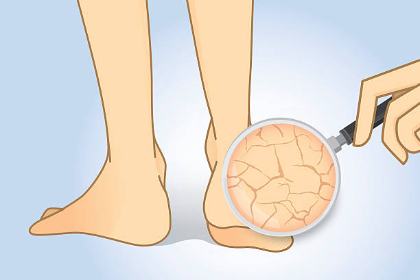 Zoom in cracked heel with magnifier. Zoom in cracked heel with magnifier. Illustration about beauty foot skin. dry skin stock illustrations