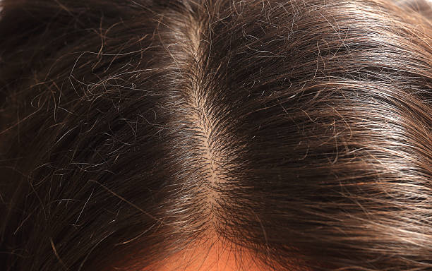istock Brown hair with dandruff. 628847944