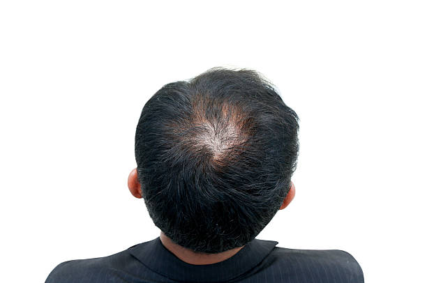 istock bald head of a man 628864172