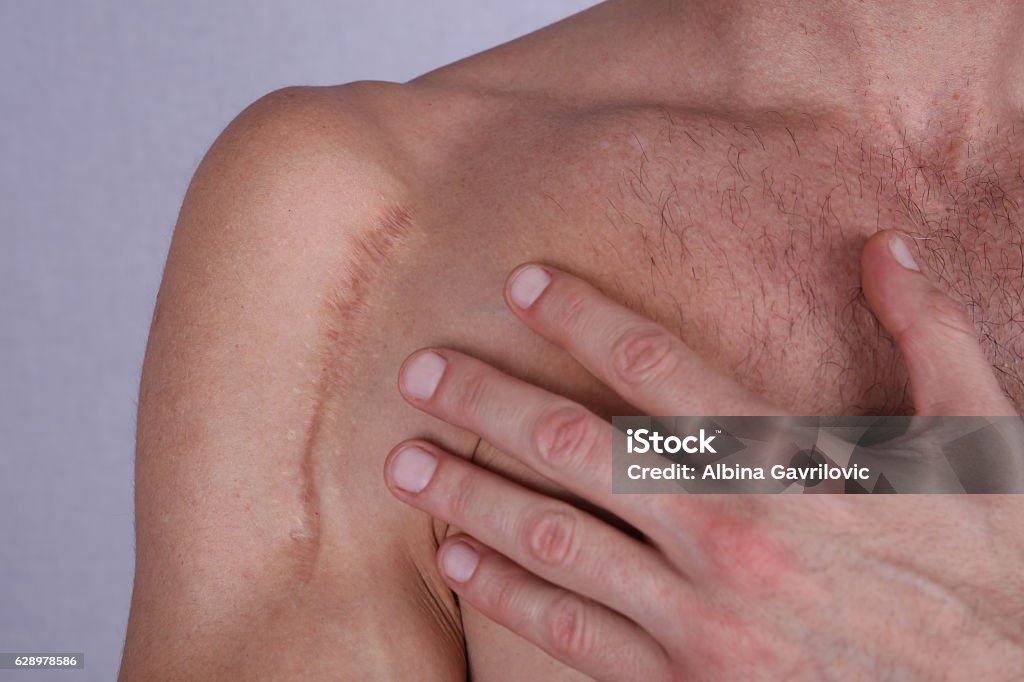 Man man with scar on his shoulder. Laser Scar Reduction Man man with scar on his shoulder. Laser Scar Reduction concept Scar Stock Photo
