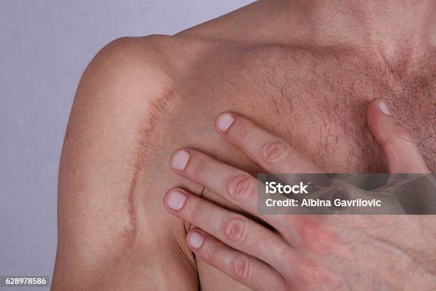 Man Man With Scar On His Shoulder Laser Scar Reduction Stock Photo - Download Image Now
