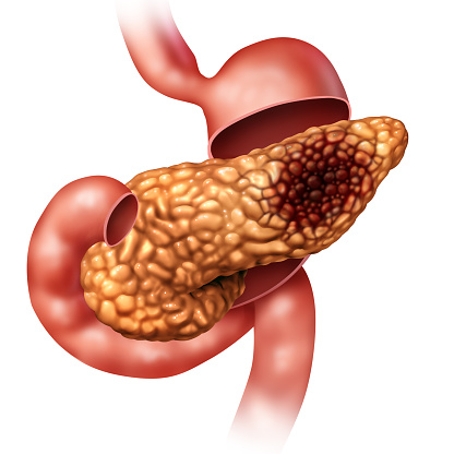 Pancreatic cancer concept and Pancreas malignant tumor symbol as a digestive gland body part with stomach cross section with a malignant tumor growth with 3D illustration elements.