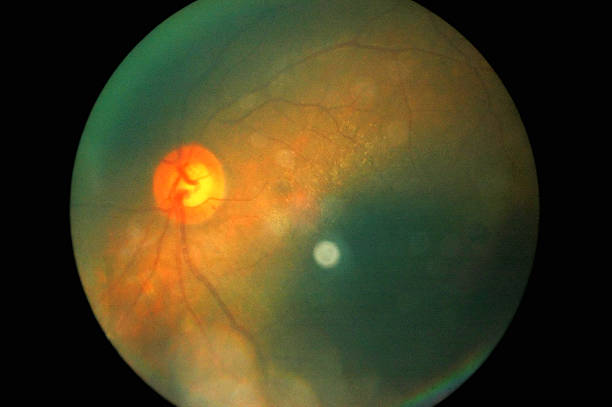 istock Retina of diabetes 629388358