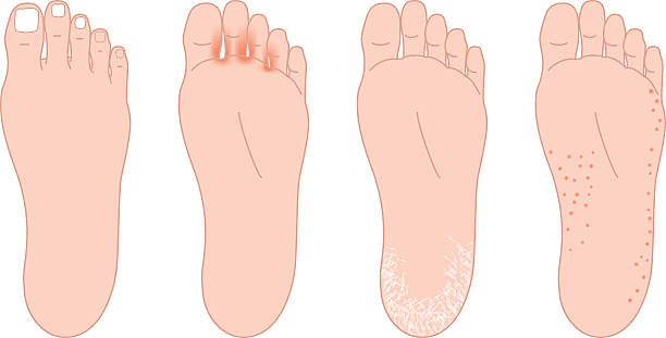 Troubles of the soles of the feet. Athlete's foot etc. Troubles of the soles of the feet. Athlete's foot etc. tinea stock illustrations